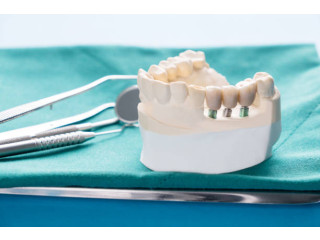 Transform Your Smile with High-Quality Dental Bridges in Brampton I Dentistry on Dusk