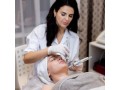 photofacial-treatment-in-mississauga-small-0