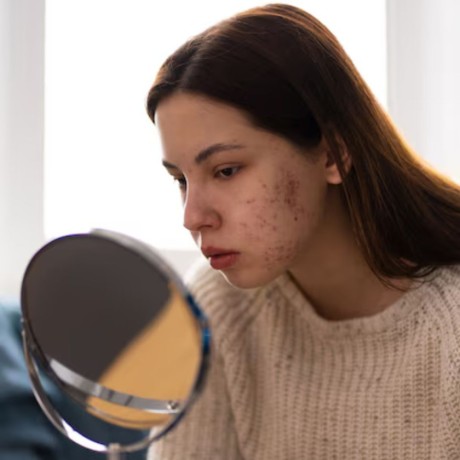 skin-care-for-acne-surrey-big-0