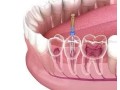 looking-for-reliable-root-canal-treatment-in-calgary-small-0