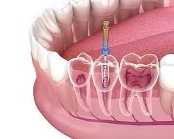 looking-for-reliable-root-canal-treatment-in-calgary-big-0