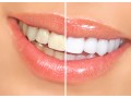 teeth-whitening-in-calgary-brighten-your-smile-with-the-best-dental-care-small-0