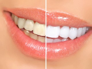 Teeth Whitening in Calgary | Brighten Your Smile with the Best Dental Care