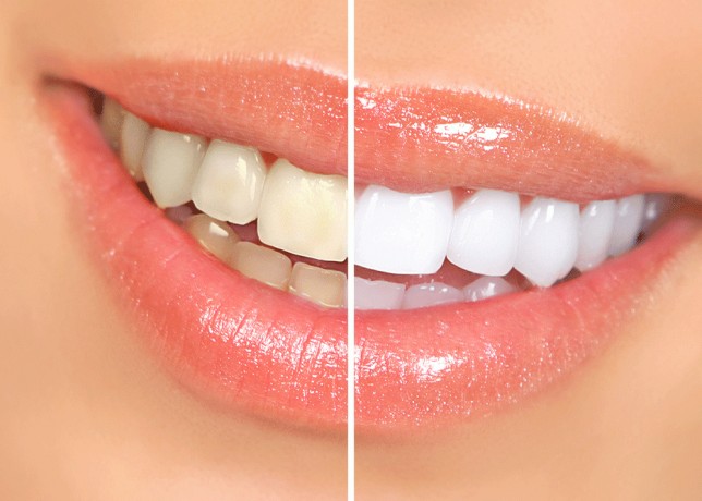 teeth-whitening-in-calgary-brighten-your-smile-with-the-best-dental-care-big-0