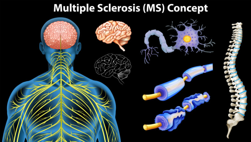 chronic-challenges-multiple-sclerosis-and-the-central-nervous-system-big-0