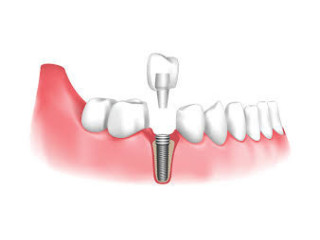 Advanced Dental Implants in Panchsheel Park: Restore Your Smile Today