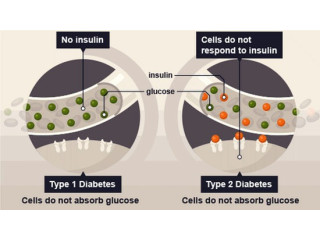 Type 1 Diabetes Stem Cell Therapy India