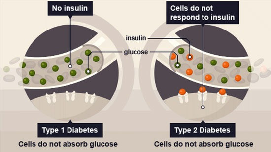 type-1-diabetes-stem-cell-therapy-india-big-0