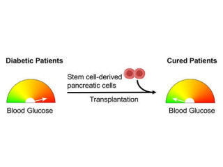 Diabetes Stem Cell Treatment India