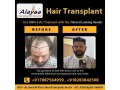 experience-hair-treatments-best-dhi-hair-transplant-clinic-in-chandigarh-small-0