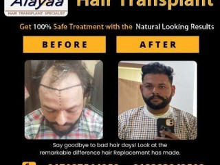 Experience Hair Treatments Best DHI Hair Transplant clinic in chandigarh