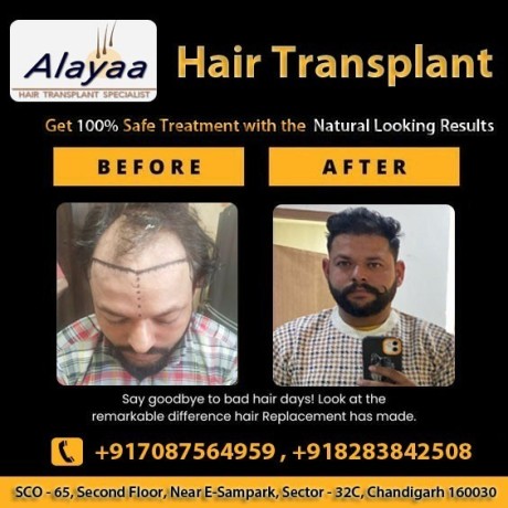 experience-hair-treatments-best-dhi-hair-transplant-clinic-in-chandigarh-big-0