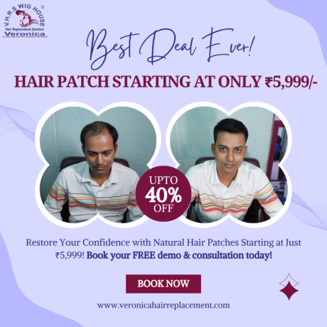 non-surgical-hair-replacement-baldness-solutions-in-delhi-big-0