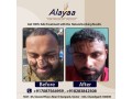 hair-transplant-specialist-in-chandigarh-hair-transplant-cost-small-0