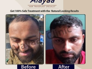 Hair Transplant Specialist in Chandigarh, Hair Transplant Cost