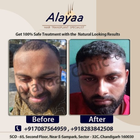 hair-transplant-specialist-in-chandigarh-hair-transplant-cost-big-0