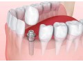 affordable-dental-implants-in-delhi-for-a-perfect-smile-small-0