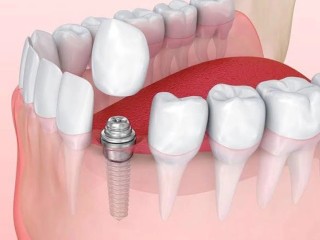 Affordable Dental Implants in Delhi for a Perfect Smile