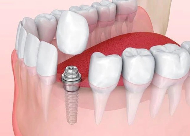 affordable-dental-implants-in-delhi-for-a-perfect-smile-big-0