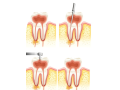 know-everything-about-root-canal-treatment-in-noida-small-0