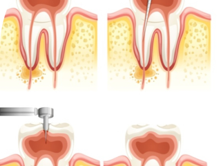 Know Everything About Root Canal Treatment in Noida