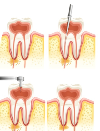 know-everything-about-root-canal-treatment-in-noida-big-0