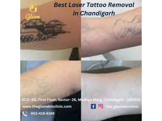 Best Laser Tattoo Removal in Chandigarh