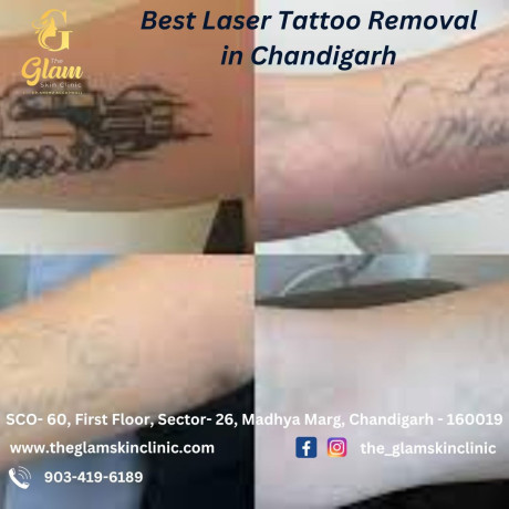 best-laser-tattoo-removal-in-chandigarh-big-0