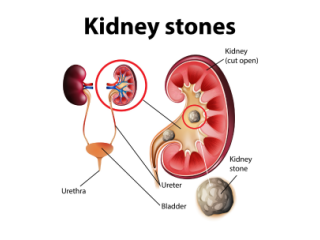 Experience Advanced Kidney Stone Treatment in Delhi
