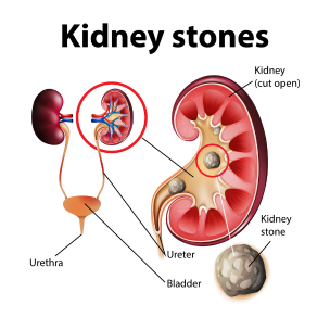 experience-advanced-kidney-stone-treatment-in-delhi-big-0