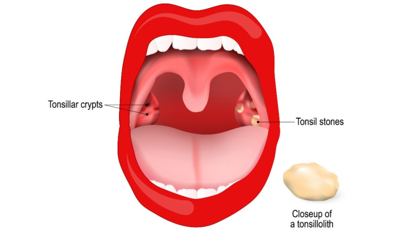 zirakpur-homeopathic-medicine-for-tonsil-stones-big-0