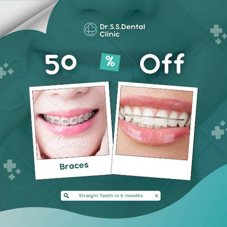 teeth-clip-treatment-in-coimbatore-big-0