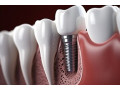 dental-implant-manufacturer-small-0