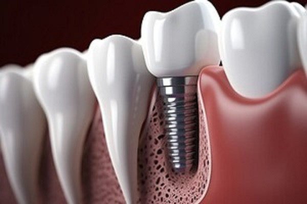 dental-implant-manufacturer-big-0