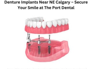 Denture Implants Near NE Calgary Secure Your Smile at The Port Dental