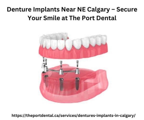 denture-implants-near-ne-calgary-secure-your-smile-at-the-port-dental-big-0