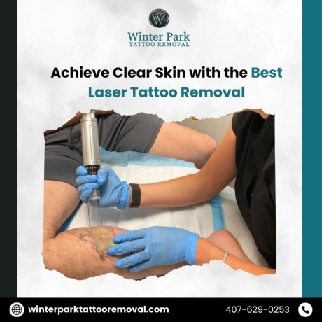 achieve-clear-skin-with-the-best-laser-tattoo-removal-big-0