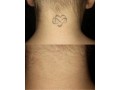 see-the-transformations-tattoo-removal-before-and-after-small-0