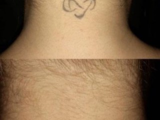 See the Transformations: Tattoo Removal Before and After