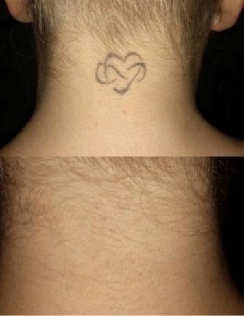 see-the-transformations-tattoo-removal-before-and-after-big-0