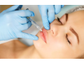 botox-in-winter-park-fl-restore-your-youthful-glow-small-0