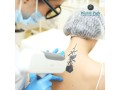 advanced-laser-tattoo-removal-effective-gentle-solutions-small-0