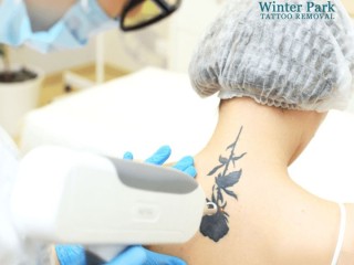 Advanced Laser Tattoo Removal - Effective & Gentle Solutions