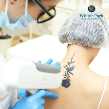 advanced-laser-tattoo-removal-effective-gentle-solutions-big-0