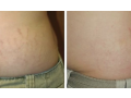 effective-solutions-for-stretch-mark-removal-small-0