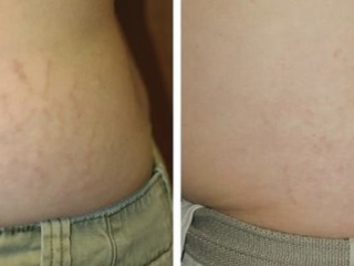 Effective Solutions for Stretch Mark Removal