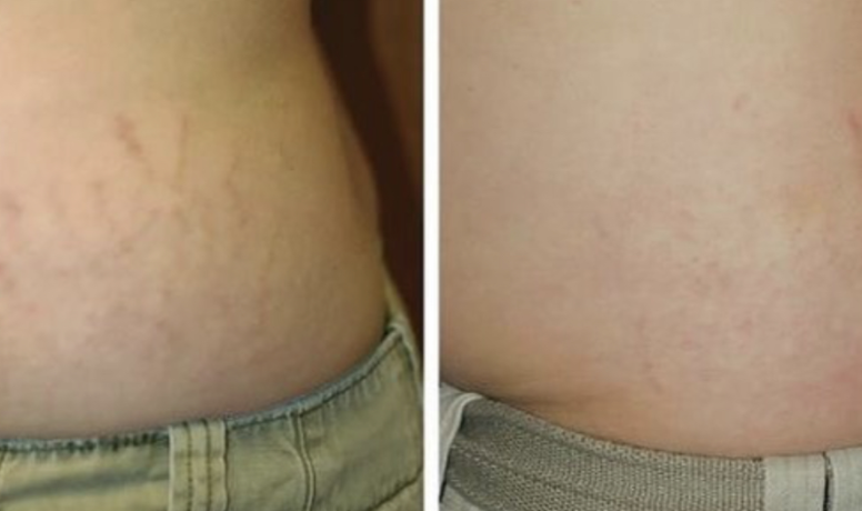 effective-solutions-for-stretch-mark-removal-big-0