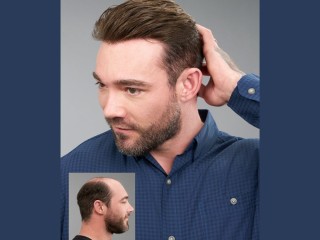 Men's Non-Surgical Hair Replacement in Yorba Linda