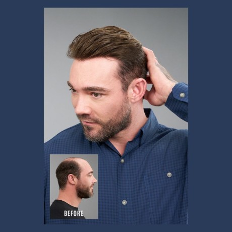 mens-non-surgical-hair-replacement-in-yorba-linda-big-0