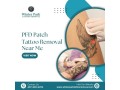 pfd-patch-tattoo-removal-near-me-faster-healing-small-0